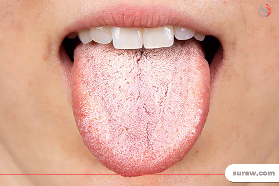 بهداشت ناکافی دهان و دندان و خشکی دهان، از جمله دلایل بوی بد دهان یا هالیتوزیس 