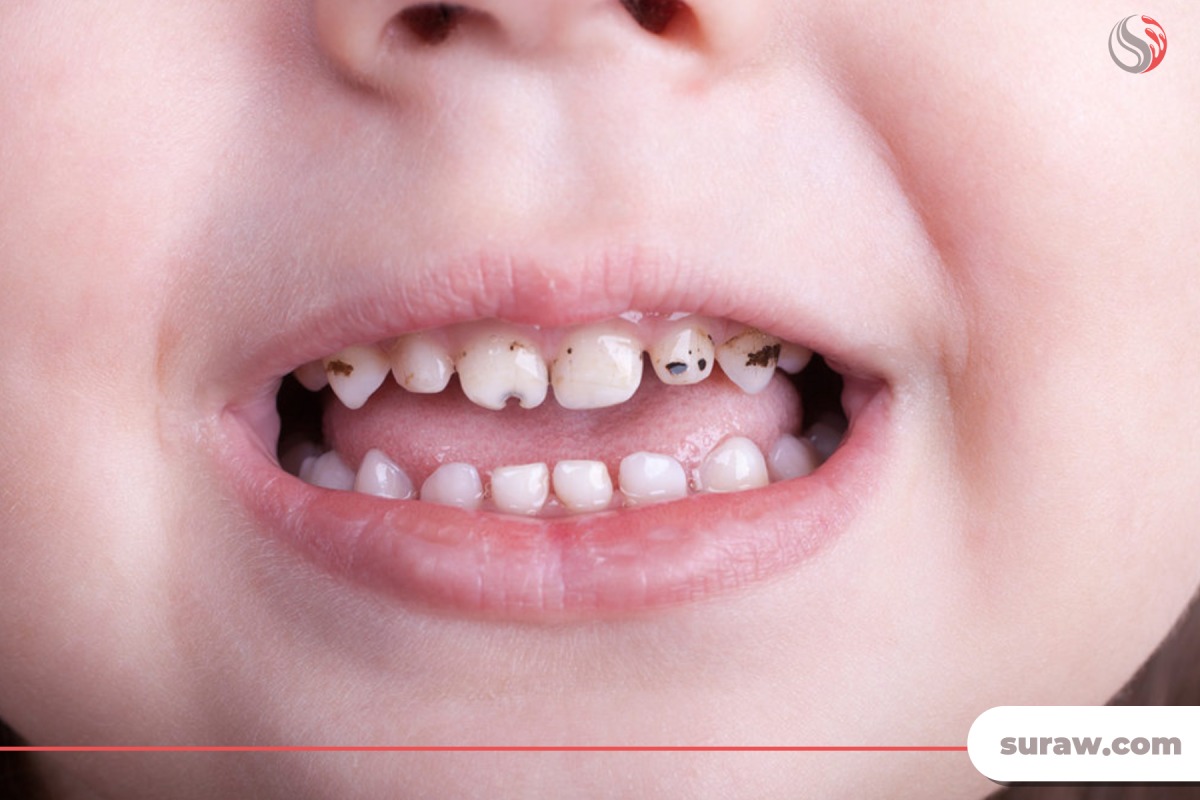 علائم پوسیدگی دندان شیری 