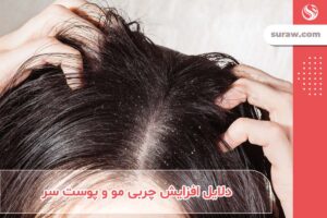 دلایل افزایش چربی مو و پوست سر + راه های درمان