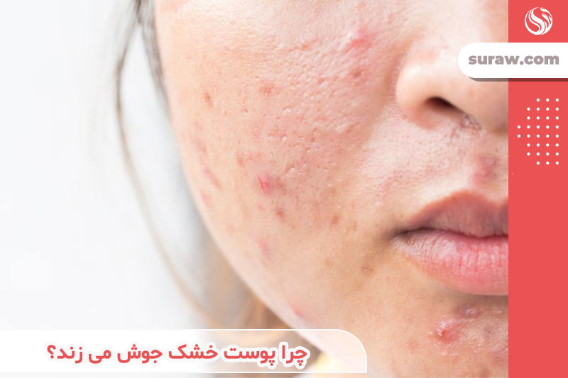 acne-on-dry-skin