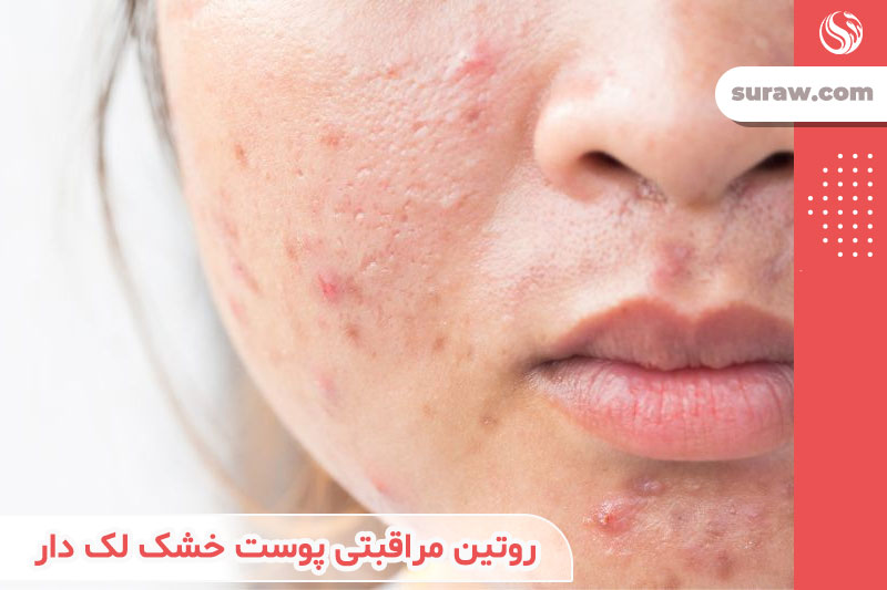 روتین مراقبتی پوست خشک لک دار + هر آنچه درباره لک های پوستی باید بدانیم ...
