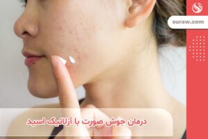 درمان جوش صورت با آزلائیک اسید