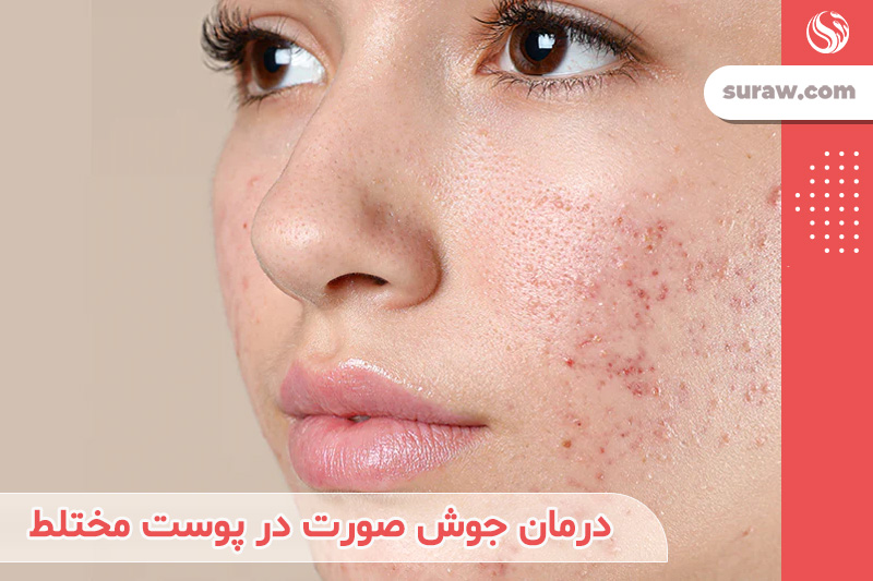درمان جوش صورت در پوست مختلط