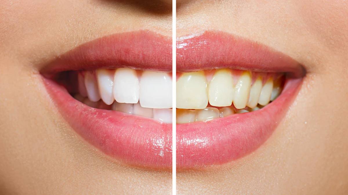 خمیر دندان سفید کننده (جرم گیر)