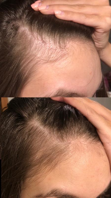 قبل و بعد استفاده از سرم تقویت و تغذیه مو پرپشت کننده د اردینری
