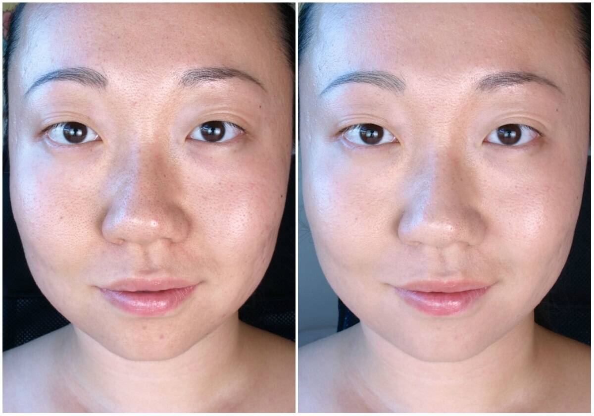 قبل و بعد استفاده از BB کرم آنتی بلمیش- پوشش طبیعی روی پوست